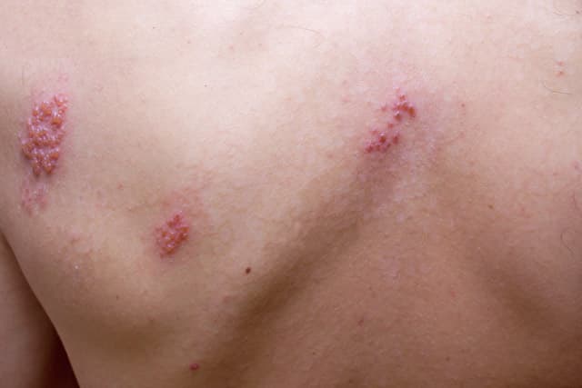 example of shingles rash
